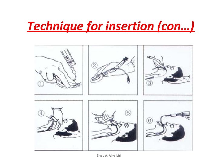 Technique for insertion (con…) Ehab A. Albalbisi 