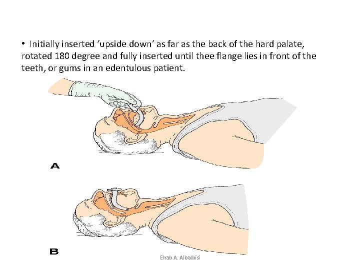  • Initially inserted ‘upside down’ as far as the back of the hard