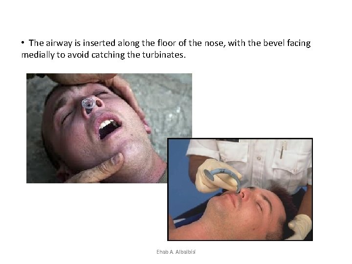  • The airway is inserted along the floor of the nose, with the
