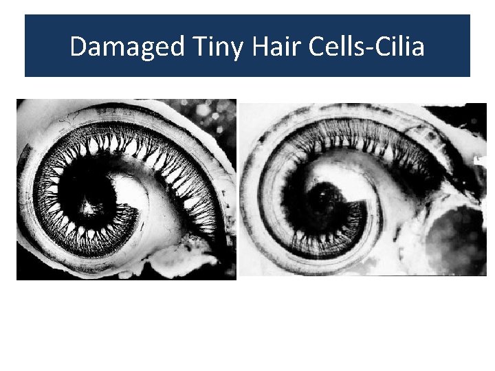 Damaged Tiny Hair Cells-Cilia 