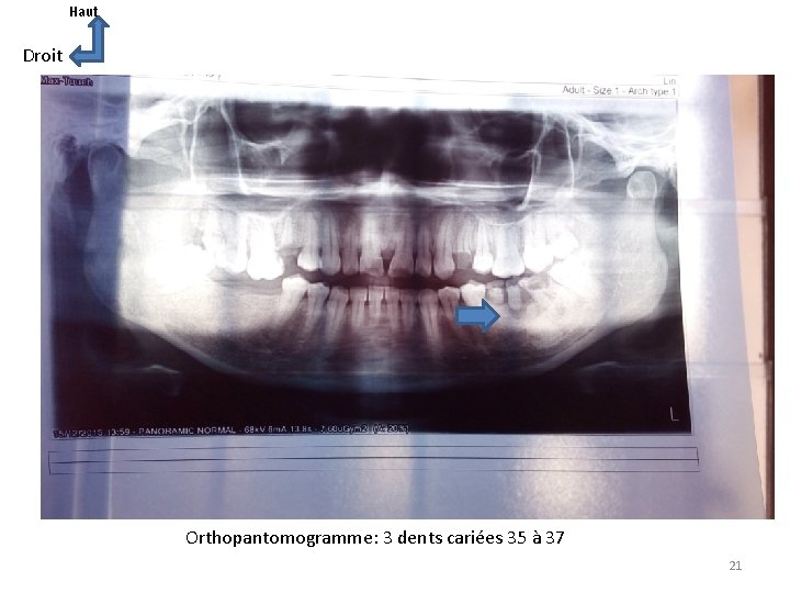 Haut Droit Orthopantomogramme: 3 dents cariées 35 à 37 21 