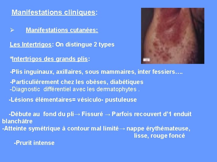  Manifestations cliniques: Ø Manifestations cutanées: Les Intertrigos: On distingue 2 types *Intertrigos des