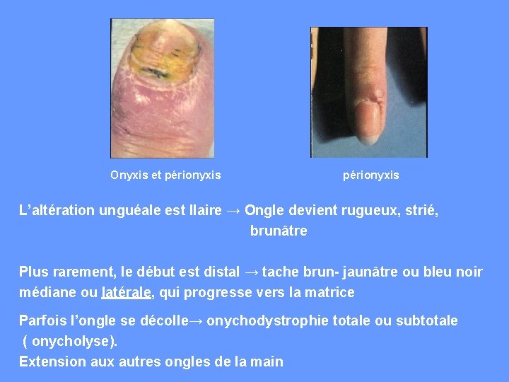  Onyxis et périonyxis L’altération unguéale est IIaire → Ongle devient rugueux, strié, brunâtre