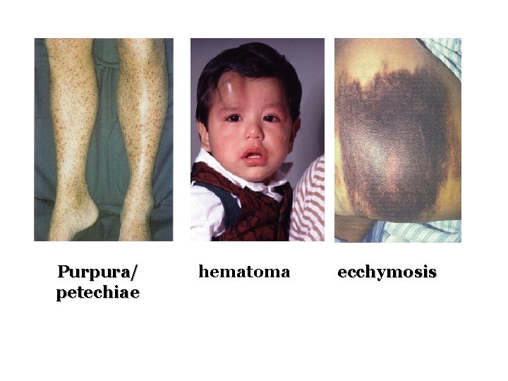 Purpura/ petechiae hematoma ecchymosis 