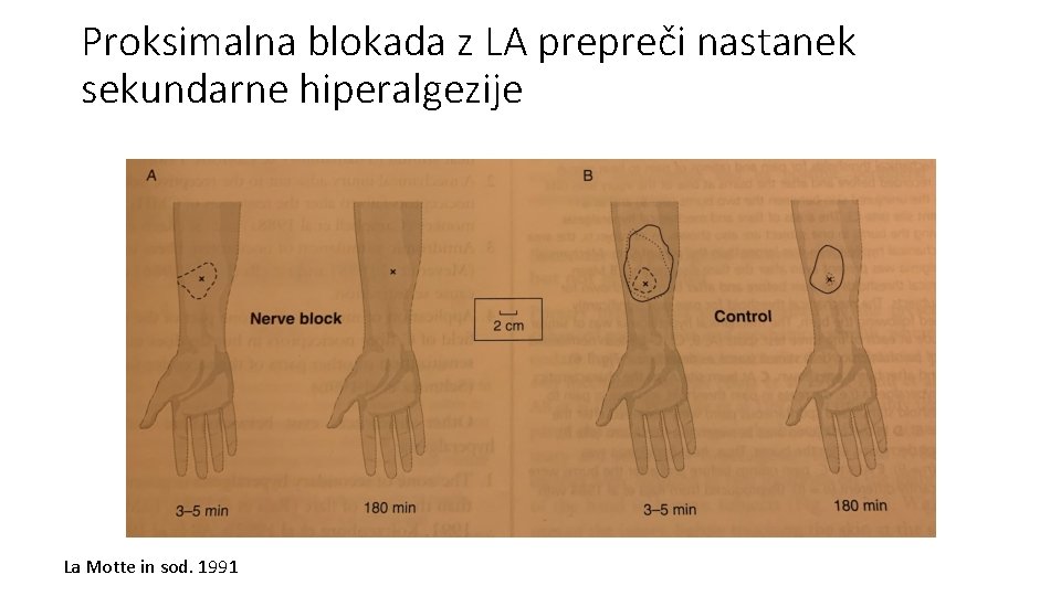 Proksimalna blokada z LA prepreči nastanek sekundarne hiperalgezije La Motte in sod. 1991 