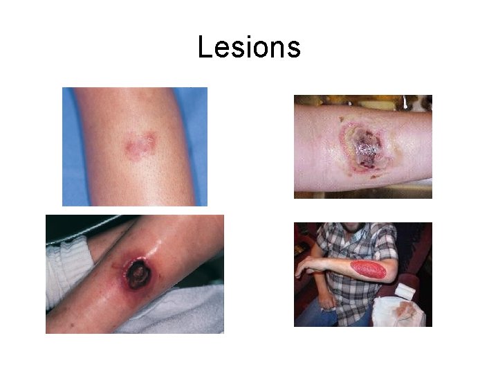 Lesions 