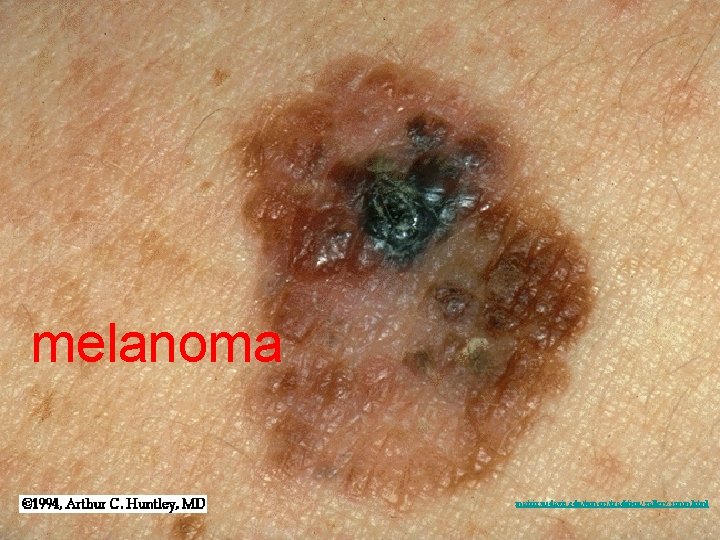 melanoma matrix. ucdavis. edu/tumors/tradition/ gallery-ssmm. html 