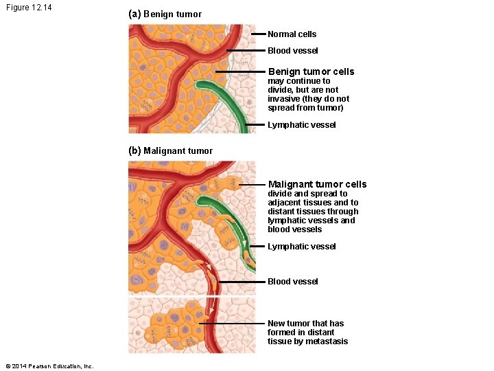 Figure 12. 14 (a) Benign tumor Normal cells Blood vessel Benign tumor cells may