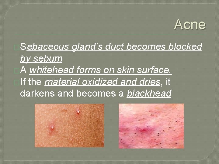 Acne �Sebaceous gland’s duct becomes blocked by sebum �A whitehead forms on skin surface.