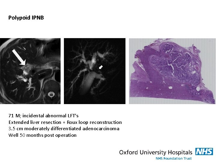 Polypoid IPNB 71 M; incidental abnormal LFT’s Extended liver resection + Roux loop reconstruction