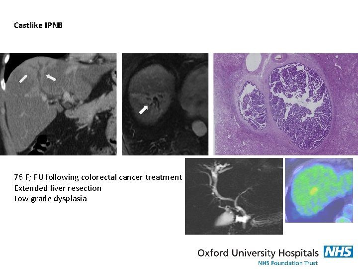 Castlike IPNB 76 F; FU following colorectal cancer treatment Extended liver resection Low grade