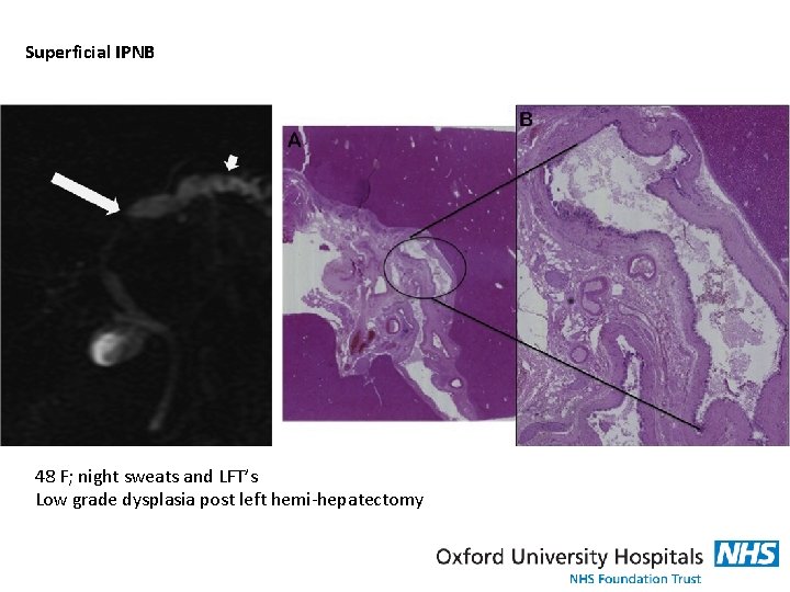 Superficial IPNB 48 F; night sweats and LFT’s Low grade dysplasia post left hemi-hepatectomy
