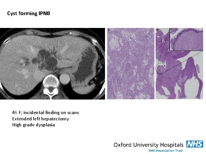 Cyst forming IPNB 46 F; incidental finding on scans Extended left hepatectomy High grade
