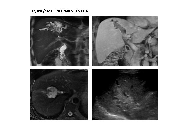 Cystic/cast-like IPNB with CCA 