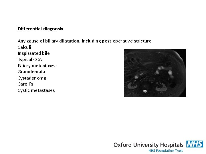 Differential diagnosis Any cause of biliary dilatation, including post-operative stricture Calculi Inspissated bile Typical