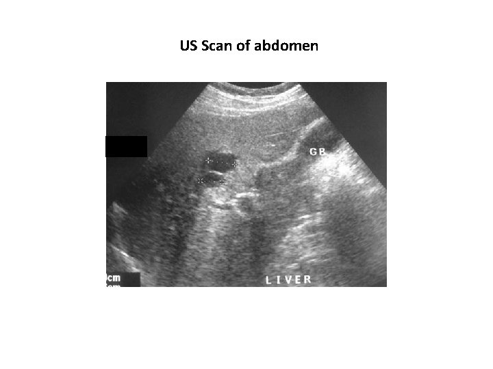 US Scan of abdomen 