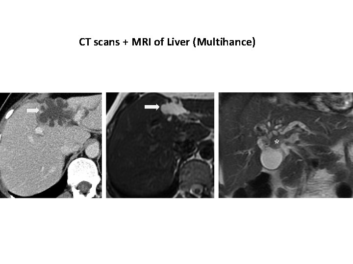 CT scans + MRI of Liver (Multihance) 