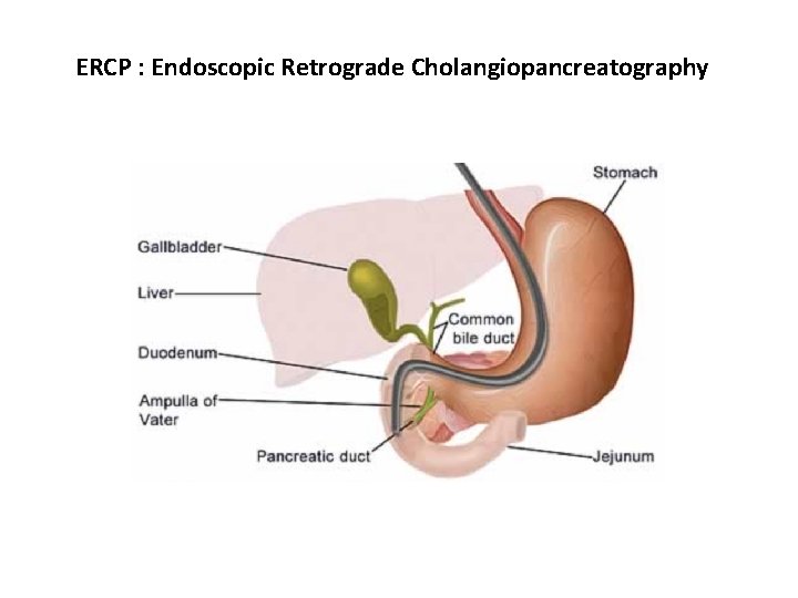 ERCP : Endoscopic Retrograde Cholangiopancreatography 
