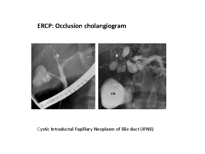 ERCP: Occlusion cholangiogram Cystic Intraductal Papillary Neoplasm of Bile duct (IPNB) 