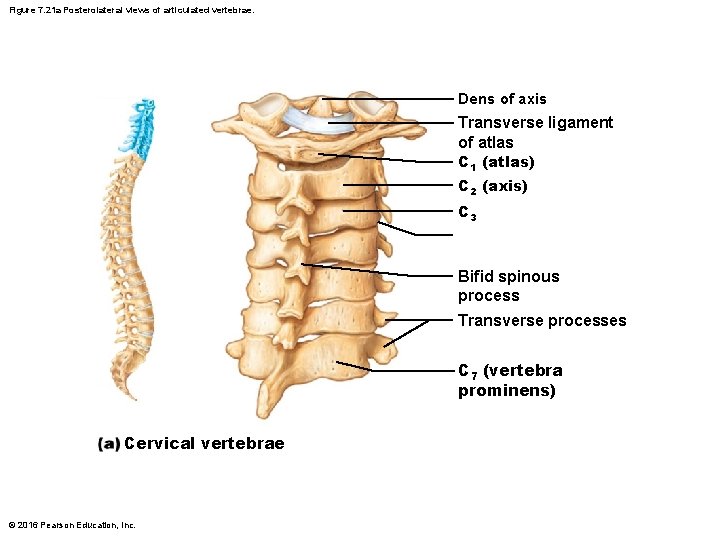 Figure 7. 21 a Posterolateral views of articulated vertebrae. Dens of axis Transverse ligament Figure 7. 21 a Posterolateral views of articulated vertebrae. Dens of axis Transverse ligament