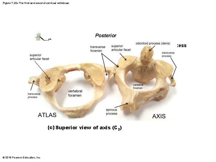 Figure 7. 20 c The first and second cervical vertebrae. Posterior C 2 Spinous Figure 7. 20 c The first and second cervical vertebrae. Posterior C 2 Spinous