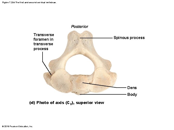 Figure 7. 20 d The first and second cervical vertebrae. Posterior Transverse foramen in Figure 7. 20 d The first and second cervical vertebrae. Posterior Transverse foramen in
