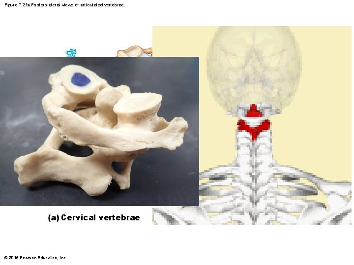 Figure 7. 21 a Posterolateral views of articulated vertebrae. Dens of axis Transverse ligament Figure 7. 21 a Posterolateral views of articulated vertebrae. Dens of axis Transverse ligament