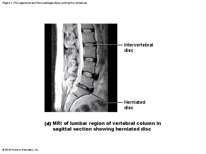 Figure 7. 17 d Ligaments and fibrocartilage discs uniting the vertebrae. Intervertebral disc Herniated Figure 7. 17 d Ligaments and fibrocartilage discs uniting the vertebrae. Intervertebral disc Herniated