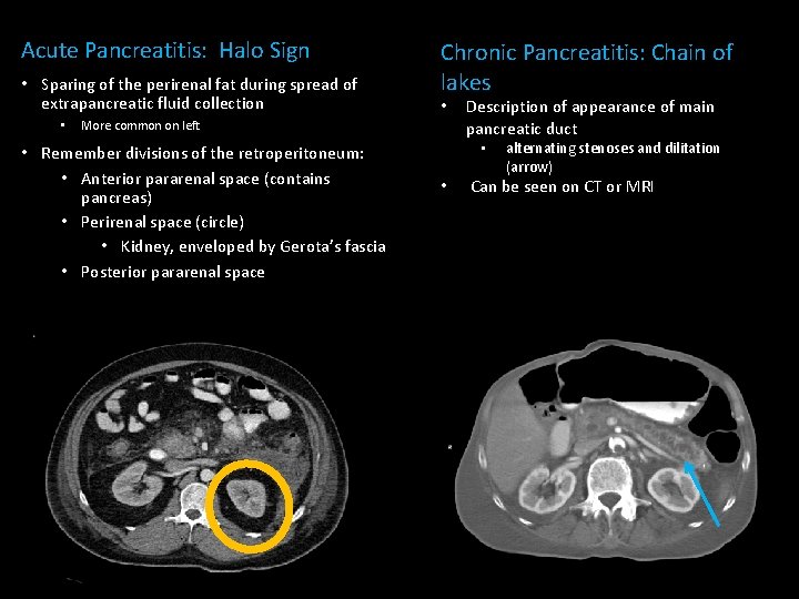 Acute Pancreatitis: Halo Sign • Sparing of the perirenal fat during spread of extrapancreatic