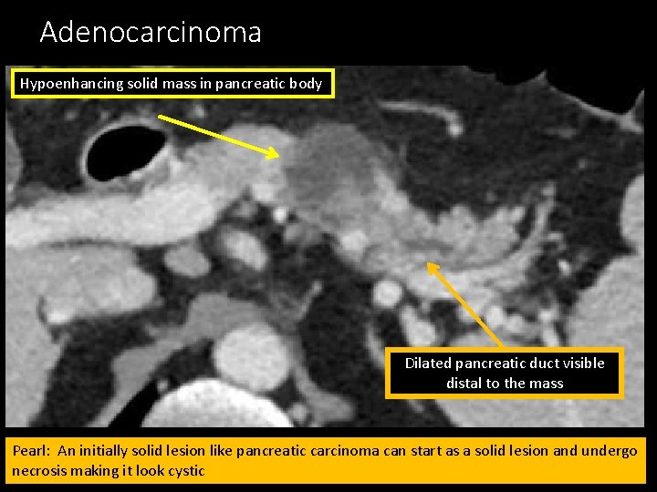 Adenocarcinoma Hypoenhancing solid mass in pancreatic body Dilated pancreatic duct visible distal to the