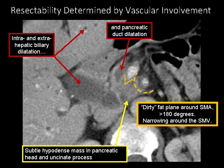 Resectability Determined by Vascular Involvement Intra- and extrahepatic biliary dilatation… and pancreatic duct dilatation