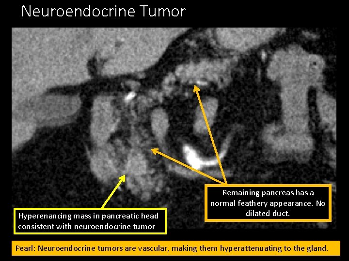 Neuroendocrine Tumor Hyperenancing mass in pancreatic head consistent with neuroendocrine tumor Remaining pancreas has