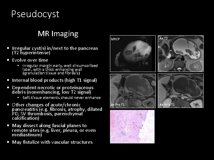 Pseudocyst MR Imaging MRCP Ax T 2 Ax Pre T 1 Ax Post T