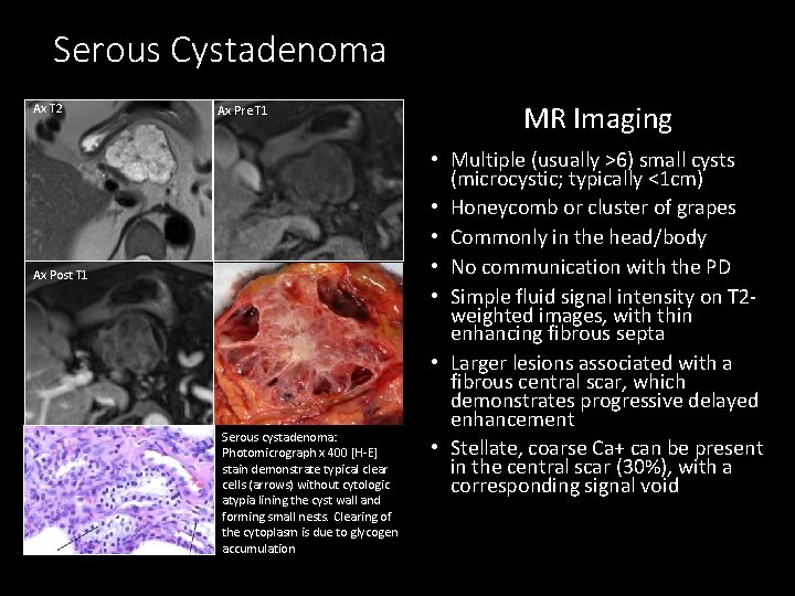 Serous Cystadenoma Ax T 2 Ax Pre T 1 Ax Post T 1 Serous