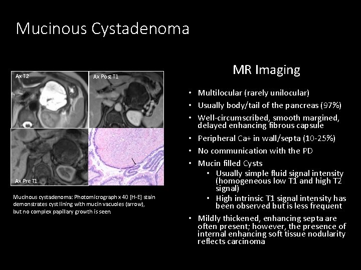Mucinous Cystadenoma Ax T 2 Ax Post T 1 Ax Pre T 1 Mucinous
