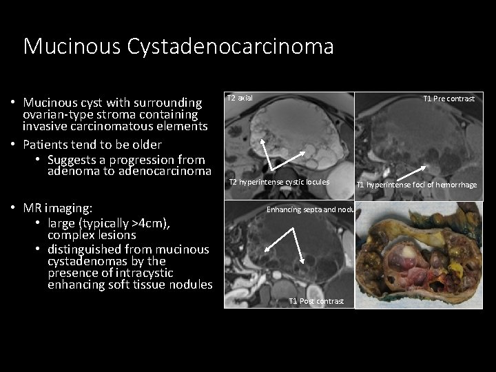 Mucinous Cystadenocarcinoma • Mucinous cyst with surrounding ovarian-type stroma containing invasive carcinomatous elements •