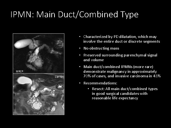 IPMN: Main Duct/Combined Type • Characterized by PD dilatation, which may involve the entire