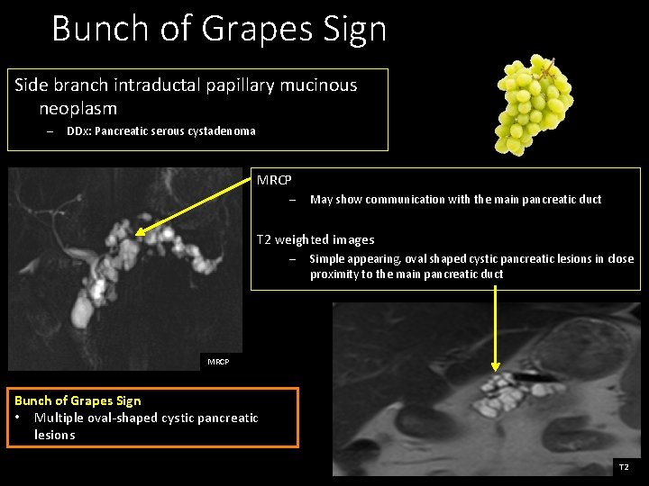 Bunch of Grapes Sign Side branch intraductal papillary mucinous neoplasm – DDx: Pancreatic serous