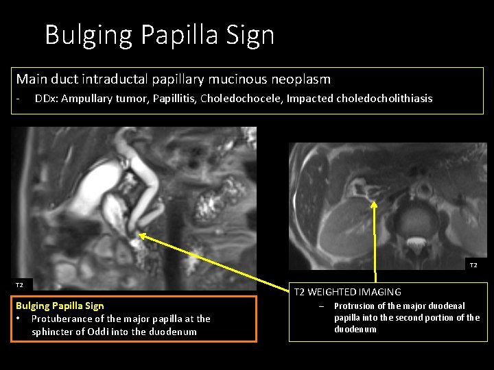 Bulging Papilla Sign Main duct intraductal papillary mucinous neoplasm - DDx: Ampullary tumor, Papillitis,