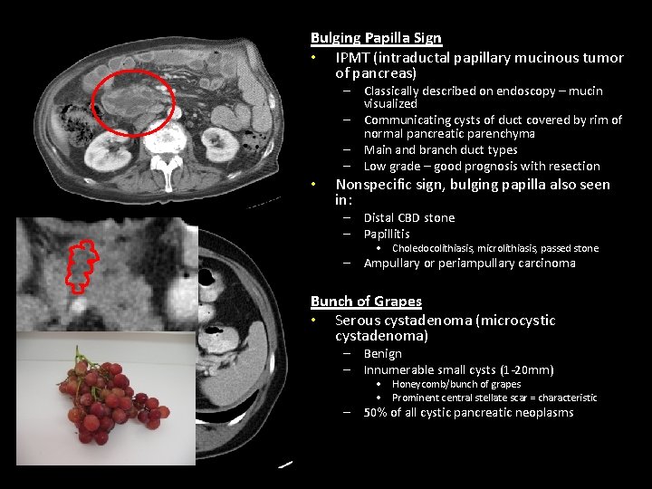 Bulging Papilla Sign • IPMT (intraductal papillary mucinous tumor of pancreas) • – Classically