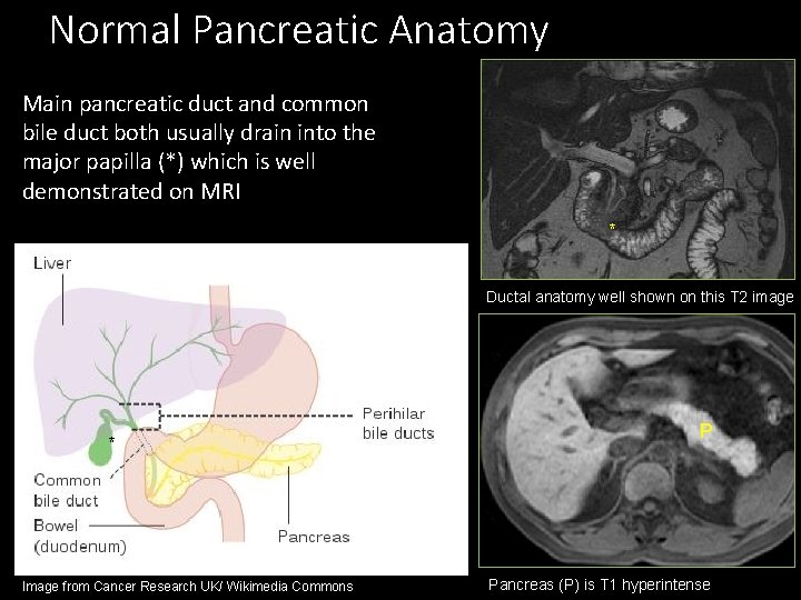 Normal Pancreatic Anatomy Main pancreatic duct and common bile duct both usually drain into