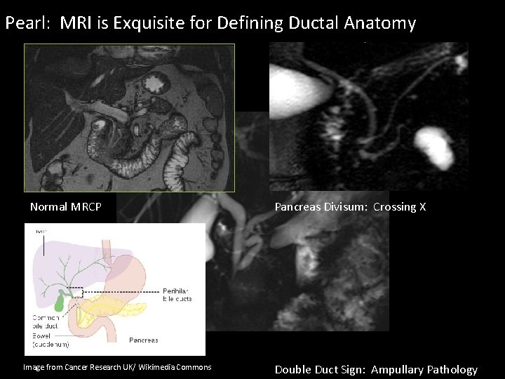 Pearl: MRI is Exquisite for Defining Ductal Anatomy Normal MRCP Image from Cancer Research