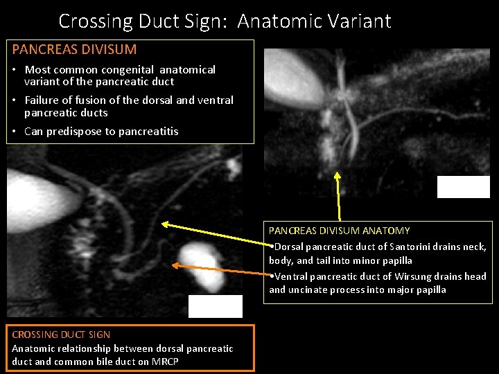 Crossing Duct Sign: Anatomic Variant PANCREAS DIVISUM • Most common congenital anatomical variant of