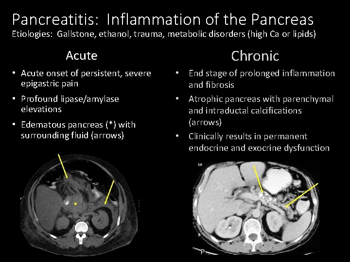 Pancreatitis: Inflammation of the Pancreas Etiologies: Gallstone, ethanol, trauma, metabolic disorders (high Ca or