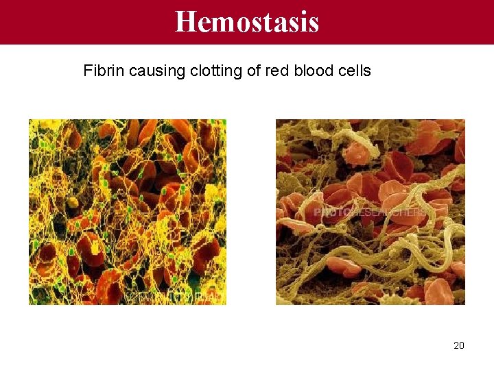 Hemostasis Fibrin causing clotting of red blood cells 20 