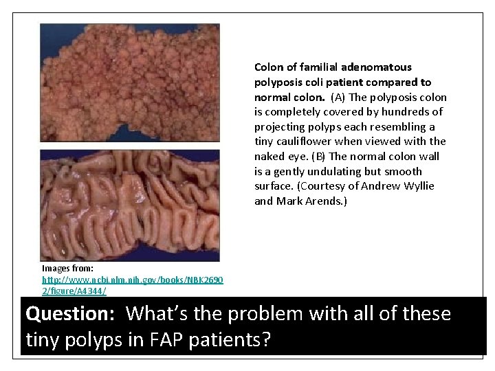 Colon of familial adenomatous polyposis coli patient compared to normal colon. (A) The polyposis