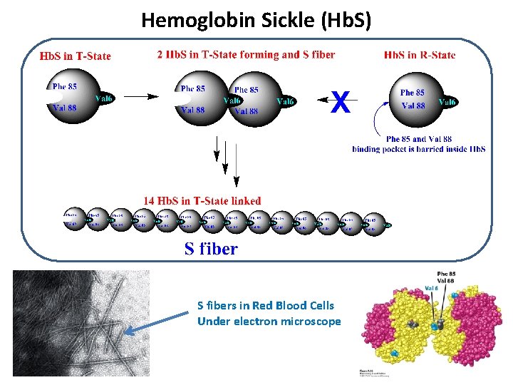 Hemoglobin Sickle (Hb. S) S fibers in Red Blood Cells Under electron microscope Hemoglobin Sickle (Hb. S) S fibers in Red Blood Cells Under electron microscope