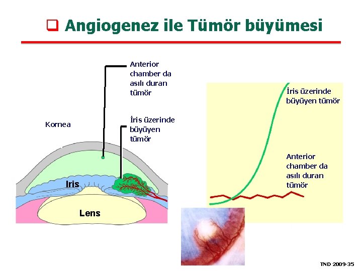 q Angiogenez ile Tümör büyümesi Anterior chamber da asılı duran tümör Tumor size İris