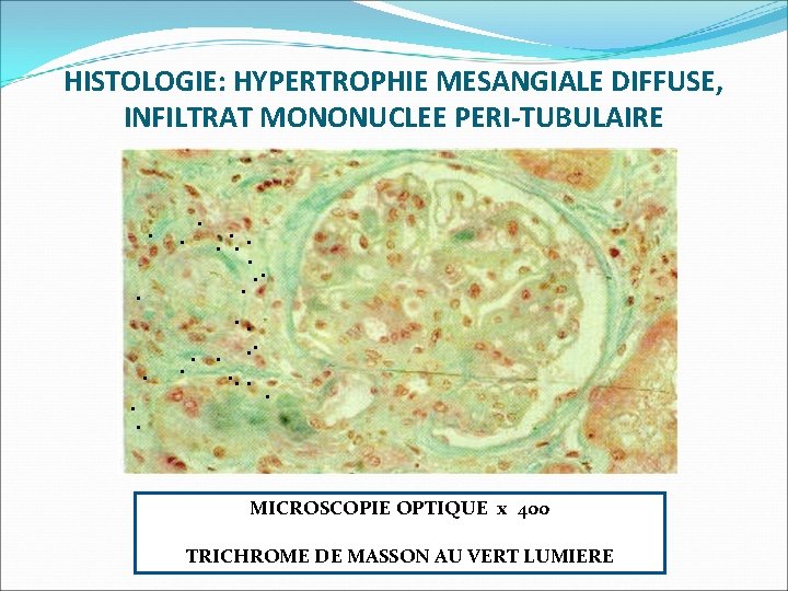 HISTOLOGIE: HYPERTROPHIE MESANGIALE DIFFUSE, INFILTRAT MONONUCLEE PERI-TUBULAIRE . . . . MICROSCOPIE OPTIQUE x