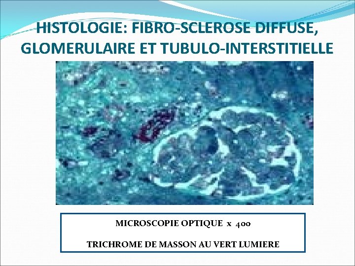 HISTOLOGIE: FIBRO-SCLEROSE DIFFUSE, GLOMERULAIRE ET TUBULO-INTERSTITIELLE MICROSCOPIE OPTIQUE x 400 MI MICROSCOPIE OPTIQUE x